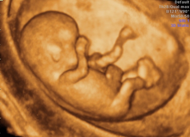 Fetus 12.Woche